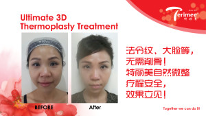 3D Ultimate Thermoplasty-08 -23-10-2014